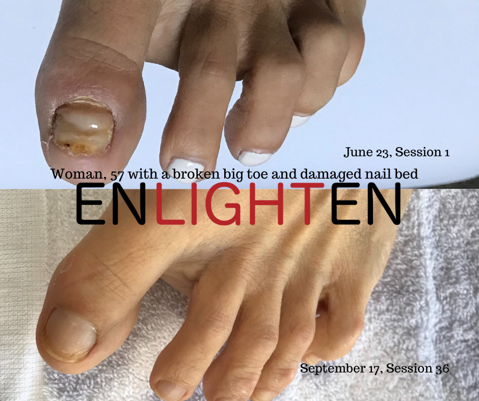 Accelerated healing broken big toe with damaged nail bed