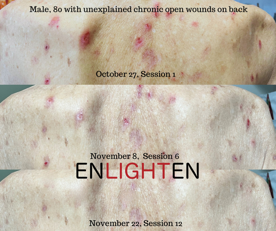 Elderly-skin-chronic-open-wound-healing-redlighttherapycenter.com_