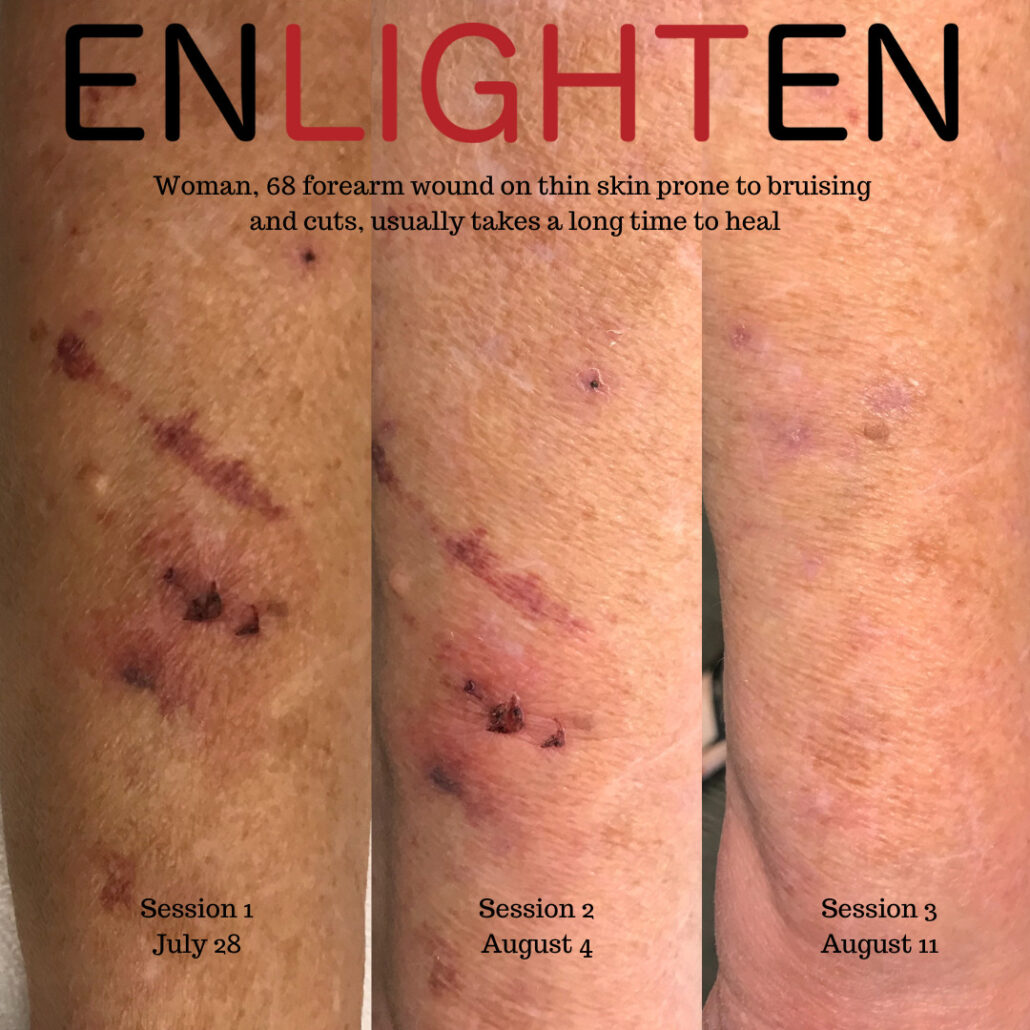 Elderly-thin-skin-prone-to-bruising-and-cuts-wound-care