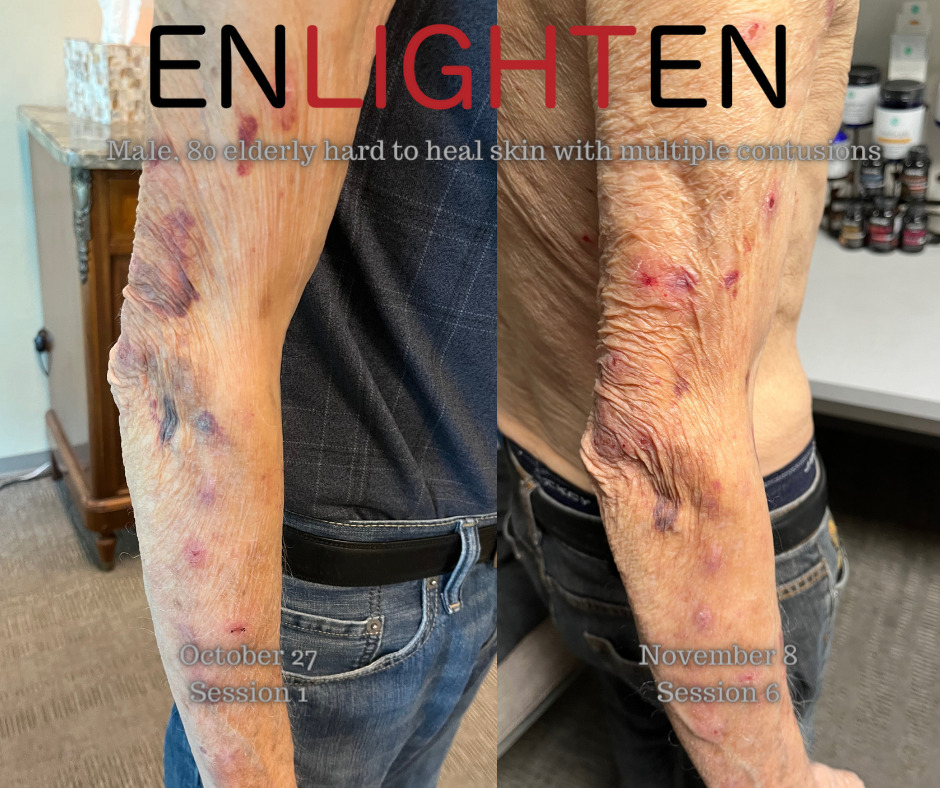 Thin-Skin-healing-elderly-hard-to-heal-skin-with-multiple-contusions