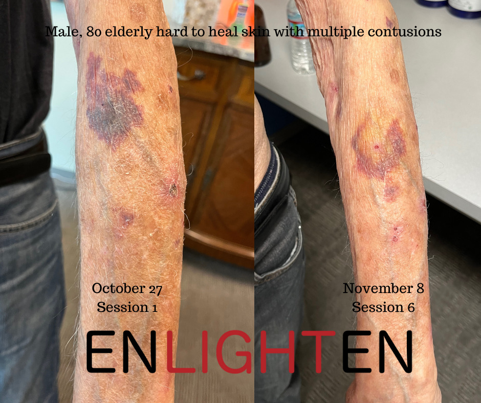 Thin-skin-bruising-treatment.-Hard-to-heal-multiple-contusions-redlighttherapycenter.com_