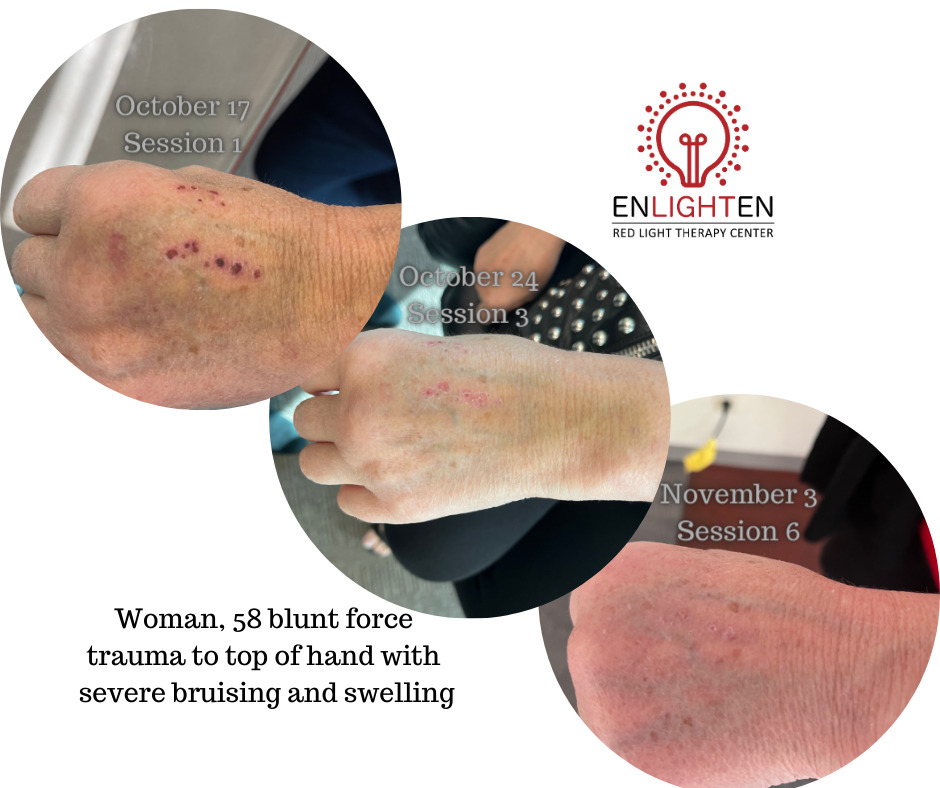 Wound healing blunt force trauma hand injury