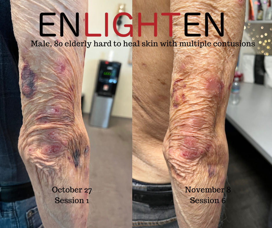 wound healing elderly skin multiple contusions