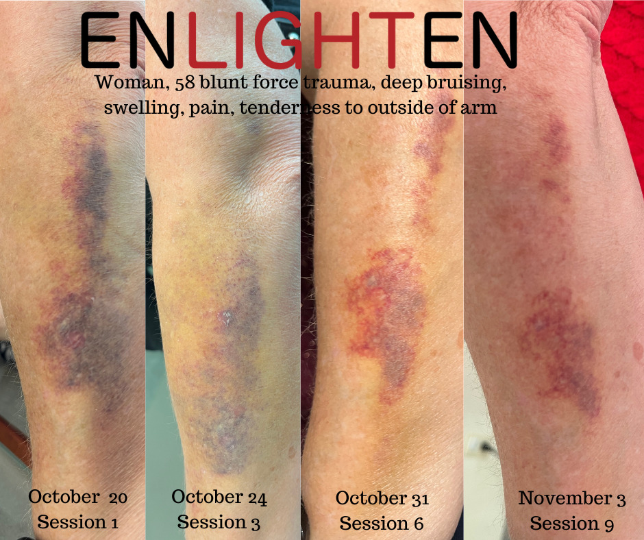 wound healing of blunt force trauma, deep bruising, swelling, pain, tenderness to outside of arm